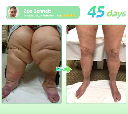 TotaI Body HeaIth Start Here 👨‍⚕️|𝖯𝗂𝗀𝗎𝗂𝖺𝗒® 𝖦𝖫𝖯-𝟣 𝖶𝖾𝗂𝗀𝗁𝗍 𝖫𝗈𝗌𝗌 𝖮𝗋𝖺𝗅 𝖲𝗈𝗅𝗎𝗍𝗂𝗈𝗇 – 𝖮𝖻𝖾𝗌𝗂𝗍𝗒, 𝖢𝖺𝗋𝖽𝗂𝗈𝗏𝖺𝗌𝖼𝗎𝗅𝖺𝗋 𝖣𝗂𝗌𝖾𝖺𝗌𝖾𝗌, 𝖣𝗂𝖺𝖻𝖾𝗍𝖾𝗌, 𝖲𝗅𝖾𝖾𝗉 𝖠𝗉𝗇𝖾𝖺, 𝖩𝗈𝗂𝗇𝗍 𝖯𝗋𝗈𝖻𝗅𝖾𝗆𝗌 𝖺𝗇𝖽 𝖬𝗈𝗋𝖾👨‍⚕️